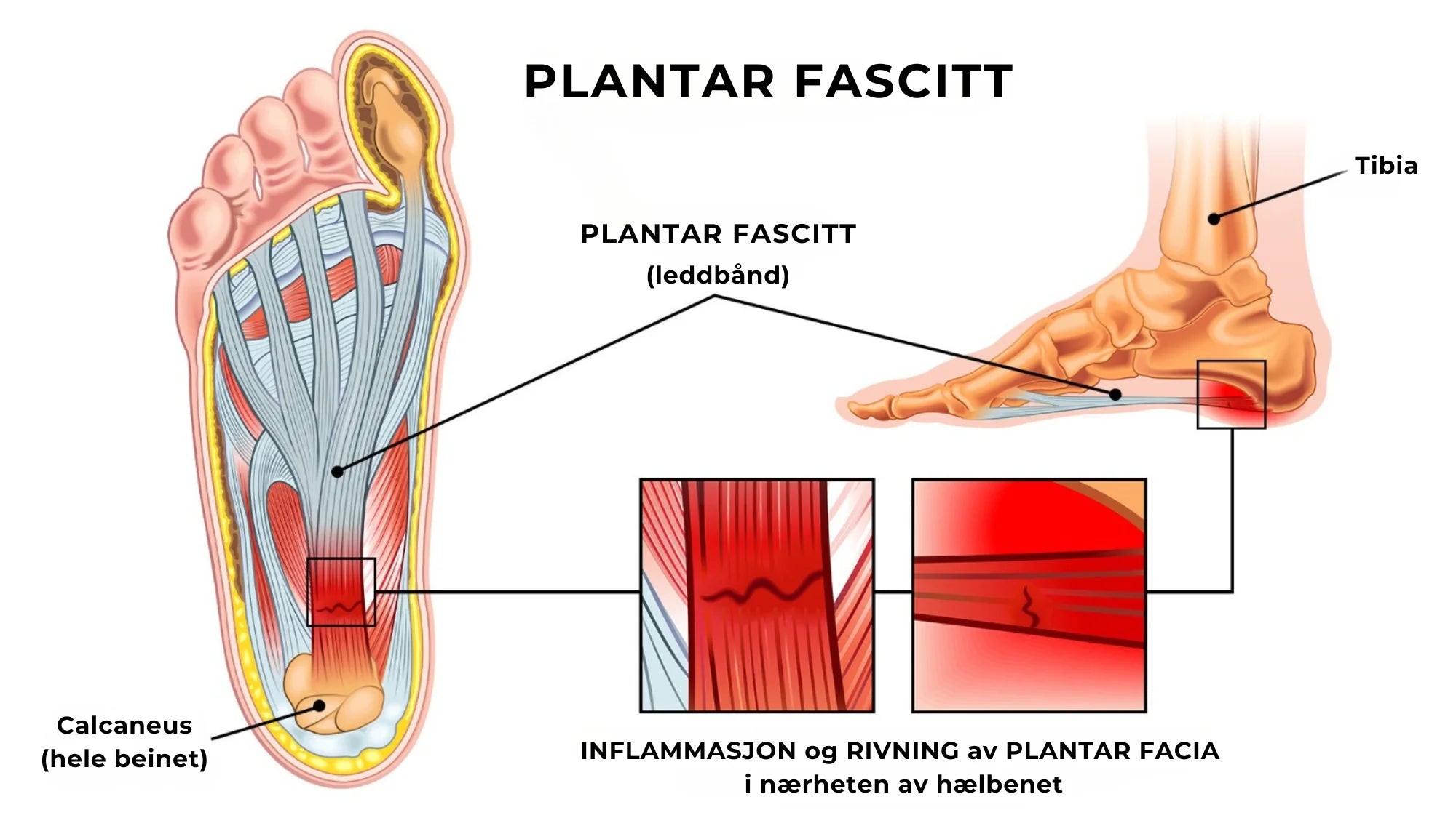 Innleggssåler-Pro™